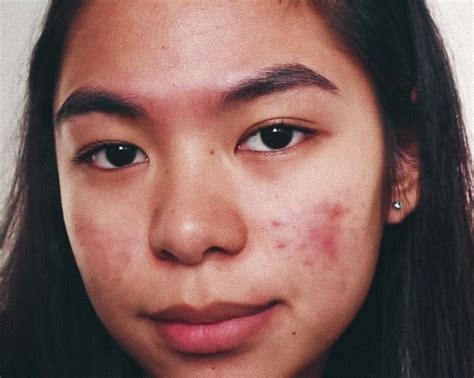 Pin By Roberto Chevez On Valiant Skin Girl With Acne Natural Acne