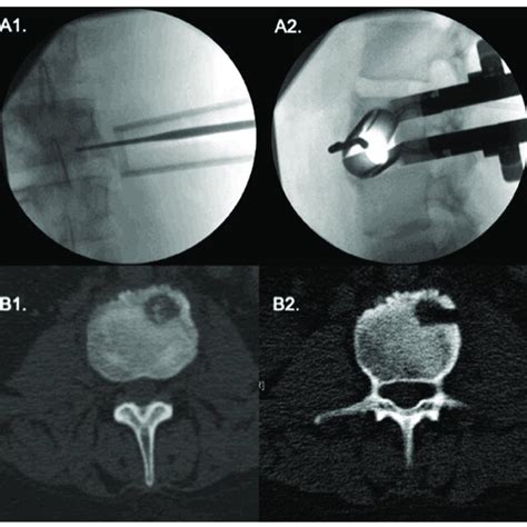 Extreme Lateral Approach To An L3 Vertebral Body Tumor A1a2