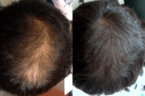 I have learned a thing or two when it comes to various ways to manage very thin, stringy, and even sparse thinning tresses! New Treatment For Thinning Hair: Platelet Rich Plasma (PRP ...