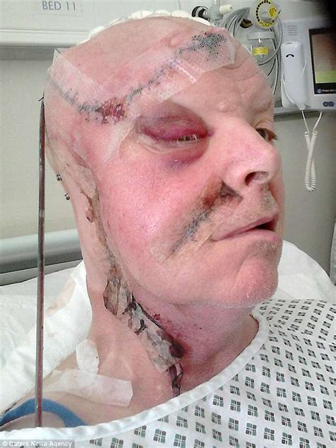 Malignant melanoma may develop on the outer ear. Grandfather free of cancer after surviving 25 years of ...
