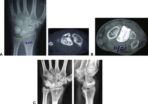 A Plain Radiograph And Axial Ct Images Of Patient Showing Fracture Of Download Scientific