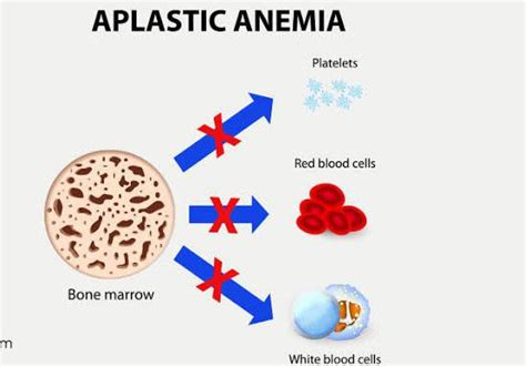 Aplastic Anemia And Its Causes Medizzy