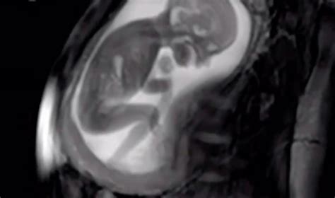 Unreal Video Watch A Fetus Move And Stretch At 20 Weeks Along