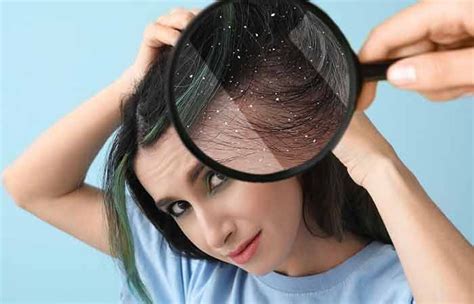 What Causes Dandruff And How To Treat It Artofit