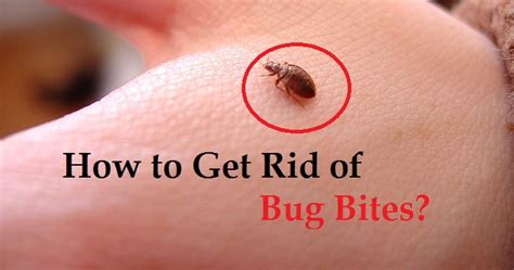 How To Get Rid Of Bug Bites