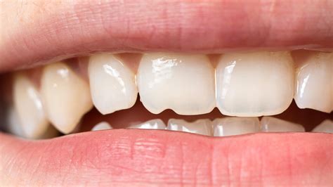 6 Ways To Manage Sensitive Teeth After Whitening Goodrx