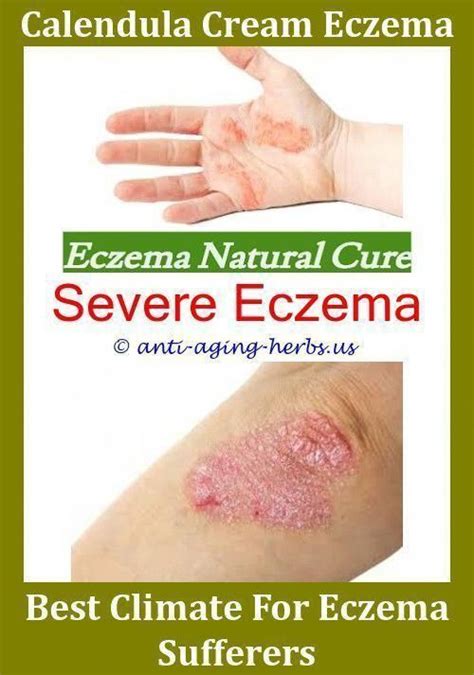 Pin On The Treatment Of Eczema