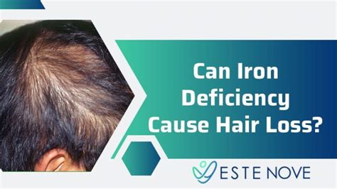Hair loss (alopecia) can affect just your scalp or your entire body, and it can be temporary or permanent. Can Iron Deficiency Cause Hair Loss? | EsteNove Hair ...