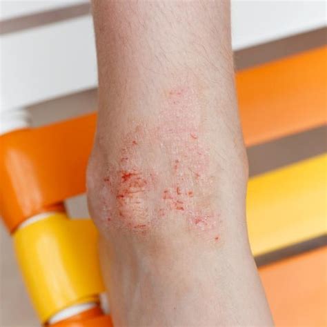 Albums 100 Pictures Eczema Rash On Legs Pictures Updated 102023