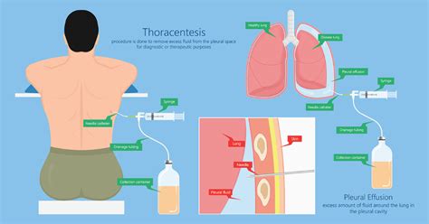 Thoracentesis Purpose Preparation Procedure Results Follow Up And Risks