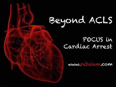 Parts 1 detecting sudden cardiac arrest 2 administering basic life support sudden cardiac arrest is the leading cause of death among adults over the age of 40 in the. Beyond ACLS - POCUS in Cardiac Arrest - REBEL EM ...
