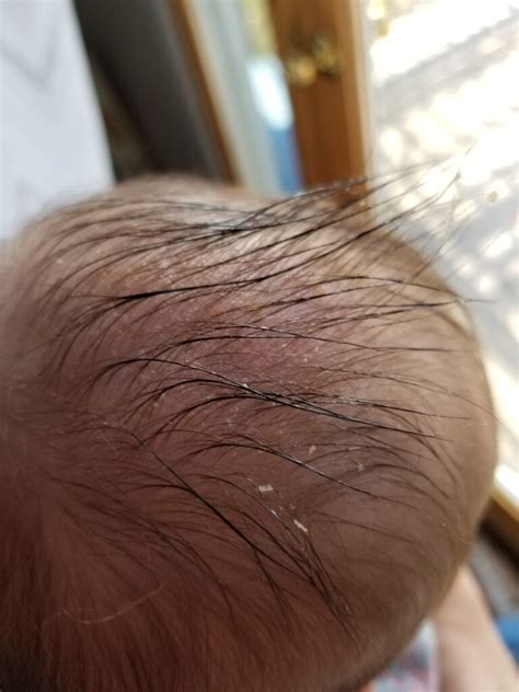 The One Simple Trick To Get Rid Of Cradle Cap For Good