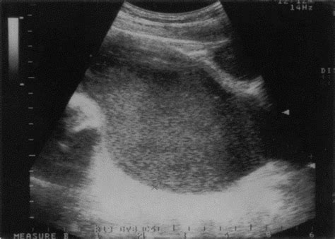 Hematocolpos In Double Vagina Associated With Uterus Didelphus US And
