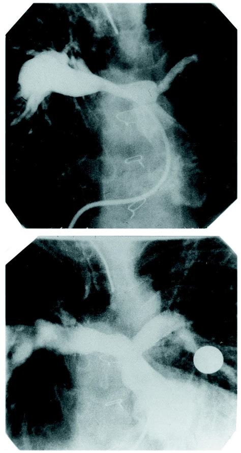 La estenosis subglótica (esg) en la granulomatosis con poliangitis (gpa) puede ser consecuencia de la enfermedad activa o de procesos inflamatorios repetitivos. Dilatación con stent de la estenosis de la arteria pulmonar en el adulto con cardiopatía ...