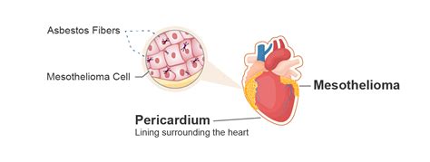 Pericardial Mesothelioma Diagnosis And Top Treatments