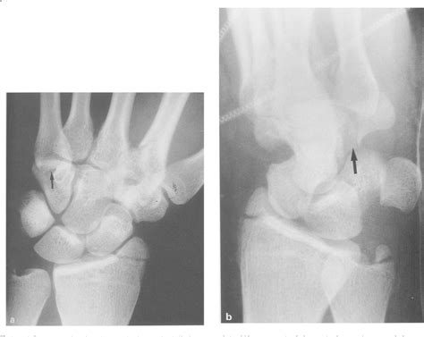 Combined Fracture Of The Hook Of The Hamate And Palmar Dislocation Of