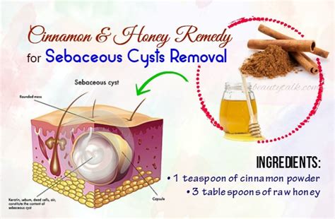 15 Remedies On How To Get Rid Of Sebaceous Cysts Naturally