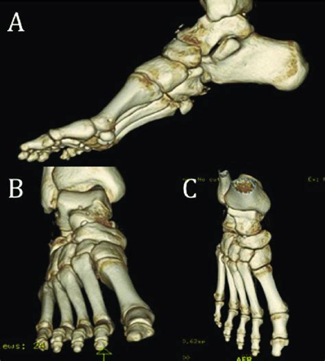 Post Operative Ct Scan Of The Right Foot Demonstrating Concentrically