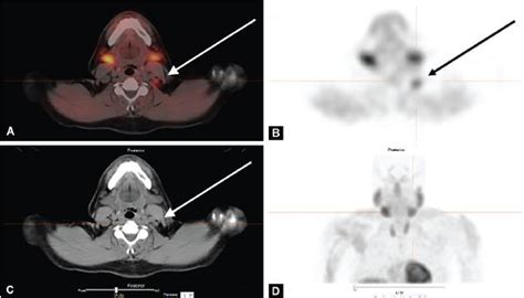 Undescended Parathyroid Adenomas A Leading Cause Of Persistent Primary