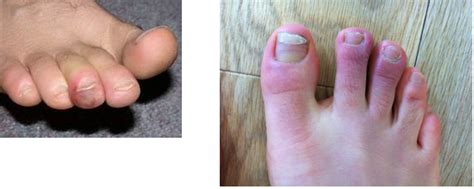 Chilblains Why My Toes Get Red Itchy And Sore In The Winter