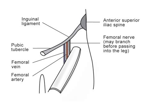Femoral Nerve Block