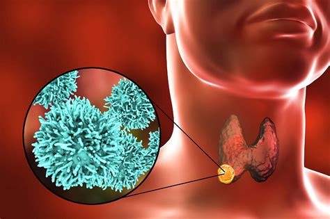 Learn the answers to this question and more at thyroid cancer (carcinoma) usually appears as a painless lump in this area. Thyroid Gland Cancer Photograph by Kateryna Kon/science ...