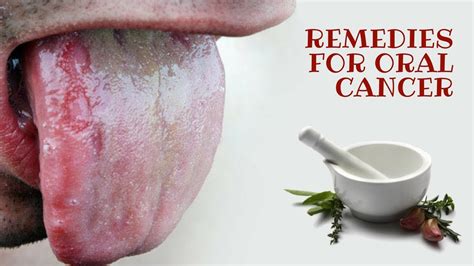 Remedies For Oral Cancer Youtube
