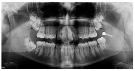 Dentistry Journal Free Full Text Uprighting Impacted Mandibular