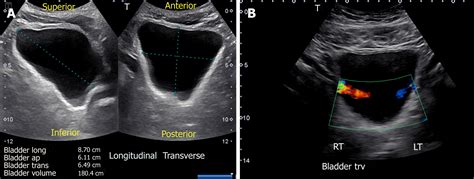 Renal Bladder Ultrasound