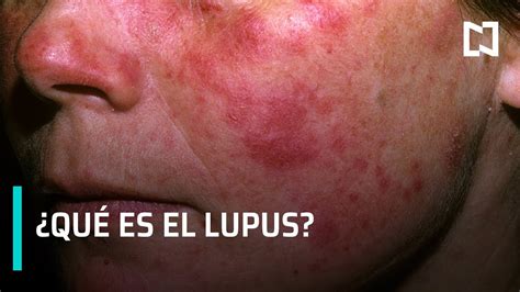 ¿qué Es El Lupus Síntomas Y Efectos Del Lupus Youtube
