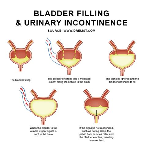 Bladder Filling And Urinary Incontinence Learn More About Types Of Urinary Incontinence Here
