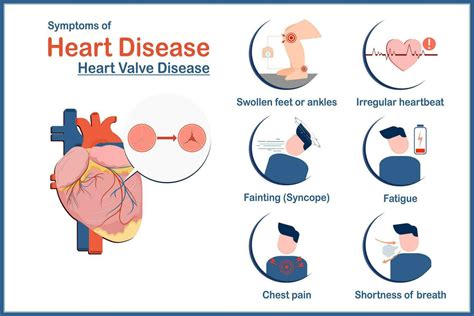 Medical Illustration Vector Conceptsymptoms Of Heart Disease Caused By