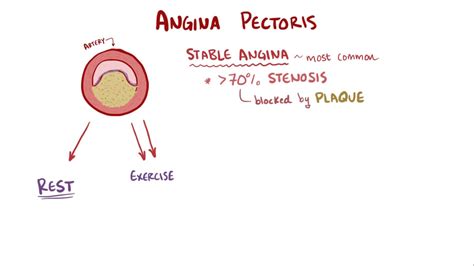Unstable angina belongs to the spectrum of clinical presentations referred to collectively as acute coronary syndromes (acss), which range from patients with unstable angina require admission to the hospital for bed rest with continuous telemetry monitoring. Angina pectoris ? stable unstable prinzmetal vasospastic ...