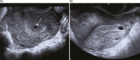 Pregnancy 4 Weeks Show Scan Beauty Clog