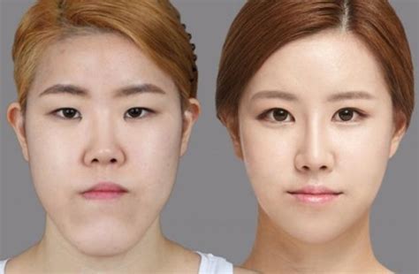 81 Photos Of Plastic Surgery In Korea That Will Make Your Jaw Drop Stomp