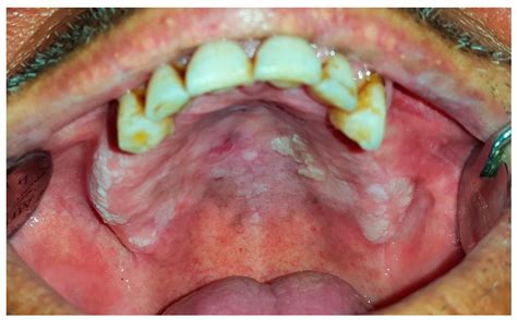 Dentistry Journal Free Full Text Oral White Lesions An Updated