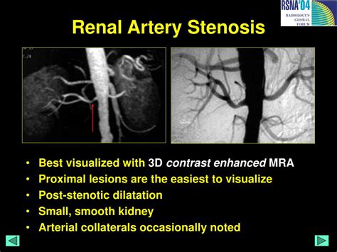 Ppt Mri Atlas Of Renal Pathology Powerpoint Presentation Id 377337