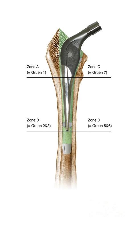 Prosthetic Hip Joint And Gruen Zones Photograph By D And L Graphics