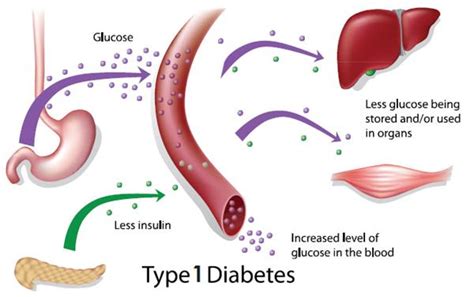 Type 1 Diabetes: Symptom, Causes, Diagnosis & Treatment » How To Relief