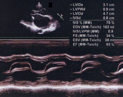 What Is M Mode Echocardiography