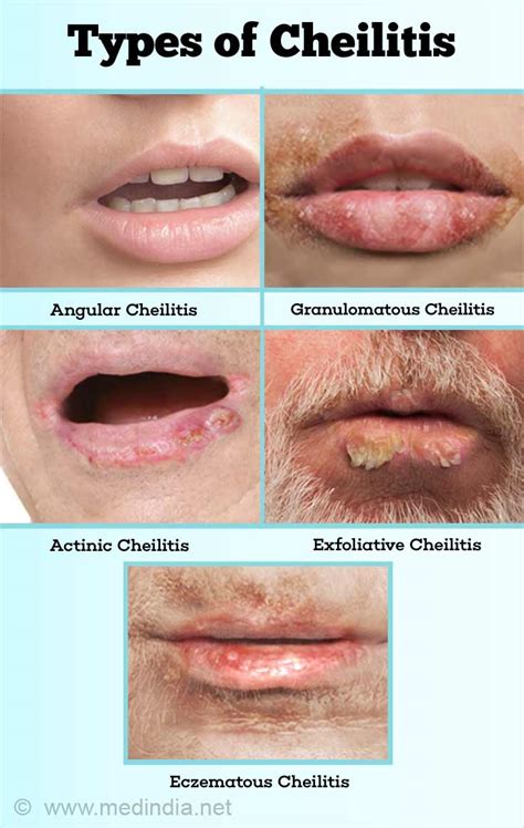 Cheilitis Causes Symptoms Diagnosis And Treatment