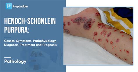 Henoch Schonlein Purpura Causes Symptoms Pathophysiology