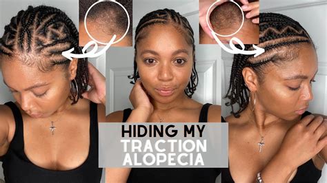 Hiding My Traction Alopecia W Cute Natural Braids Two Layer Braids On