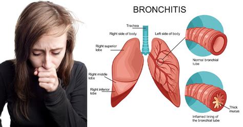 Bronchitis Remedies Fi Chronic Fatigue Symptoms Chronic Fatigue