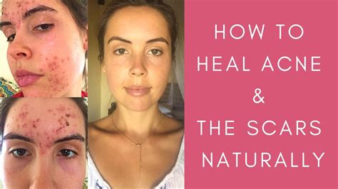 HOW TO HEAL ACNE SCARS NATURALLY Is Accutane A Solution For Hormonal