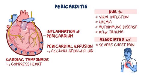 Pericarditis Clinical Sciences Osmosis Video Library