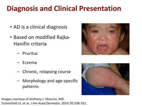 Essential Updates In Atopic Dermatitis Pathophysiology Prevalence