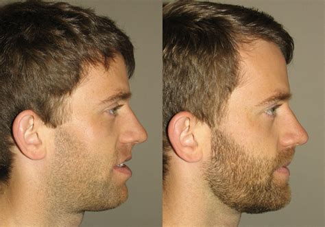Corrective Jaw Surgery Photo Patient 6 Guyette Facial And Oral Surgery