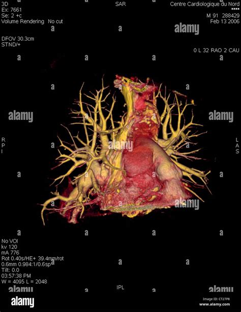 Pulmonary Artery 3d Scan Stock Photo Alamy