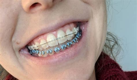 Best Color Braces For White Teeth Warehouse Of Ideas